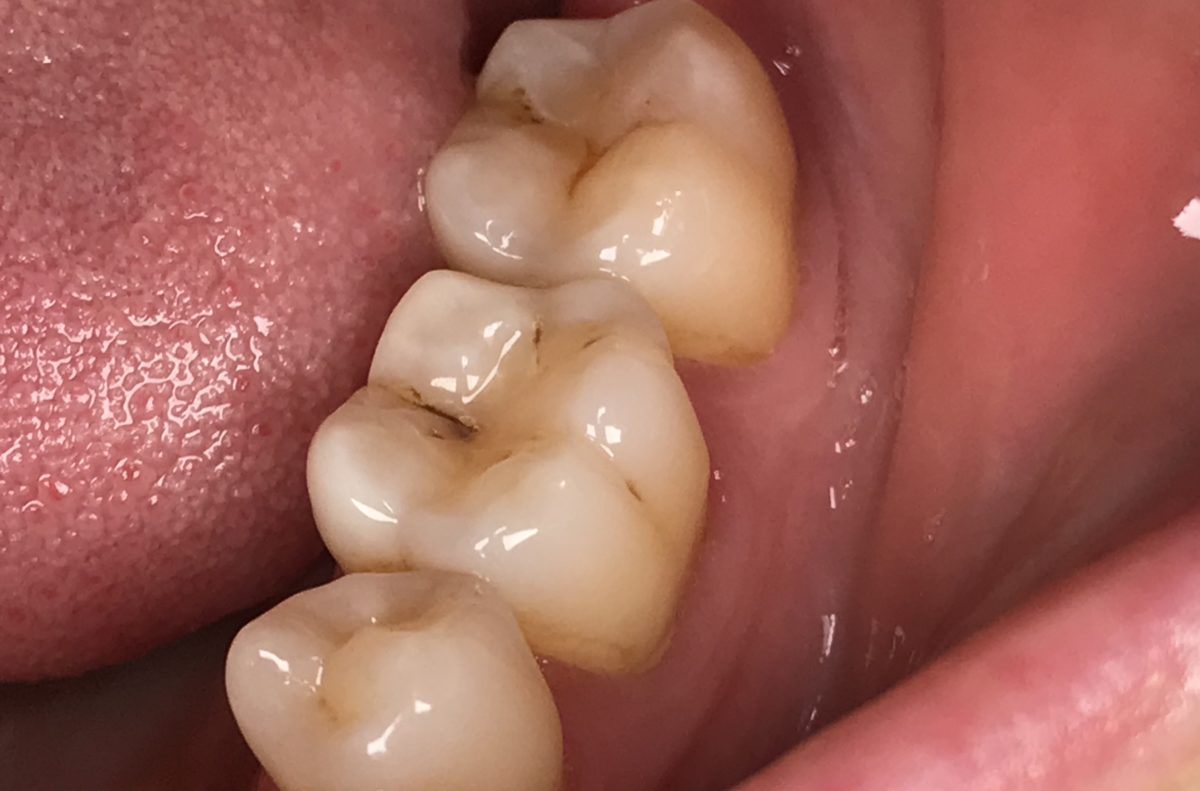 Mitä ovat pienet mustat pisteet hampaissa?