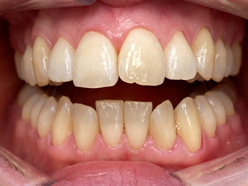 invisalign-kalvo-oikominen-ennen-ja-j-lkeen-hammaspaikka